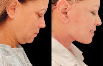 female patient before and after Eve Lift procedure