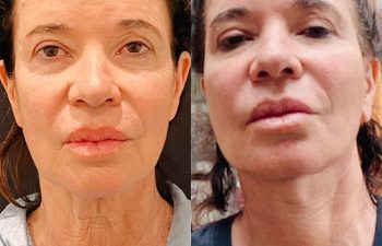 EVE Lift Before and After