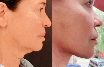 EVE Lift Before and After