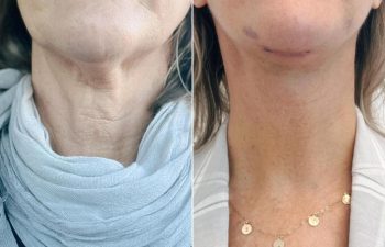 EVE Lift Before and After