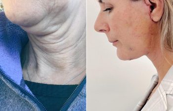 EVE Lift Before and After