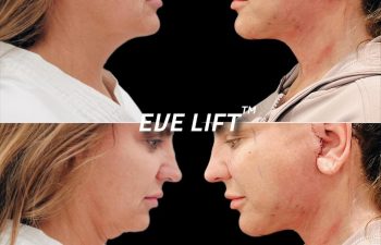 EVE Lift Before and After