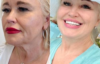 EVE Lift Before and After