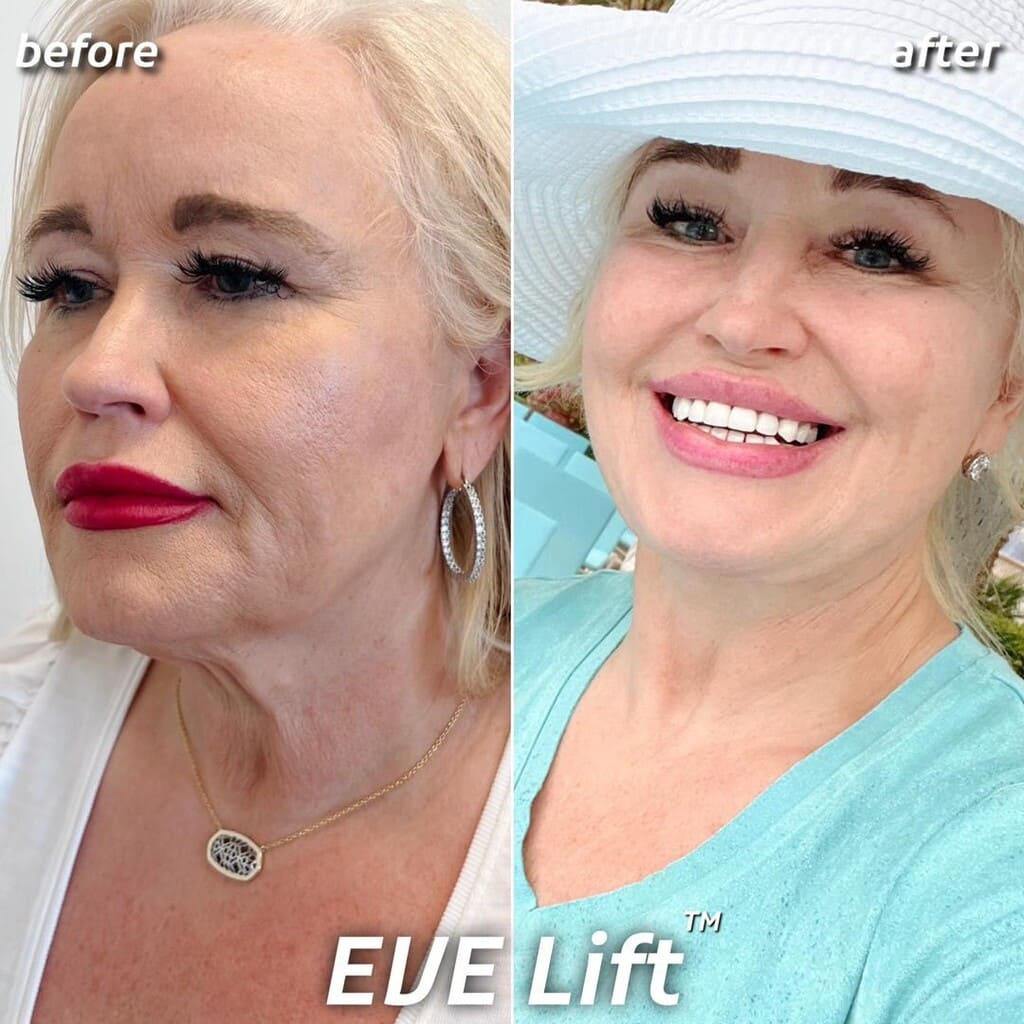 EVE Lift Before and After