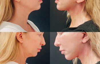 female patient before and after Eve Lift procedure