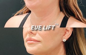 female patient before and after Eve Lift procedure