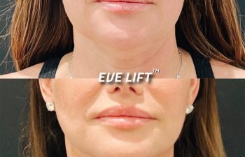 female patient before and after Eve Lift procedure