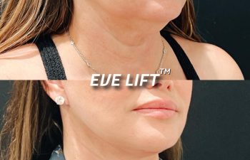 female patient before and after Eve Lift procedure