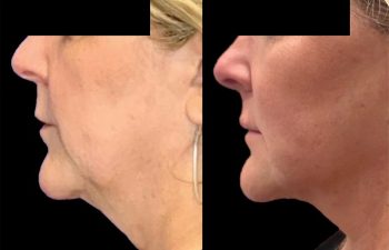 female patient before and after Eve Lift procedure