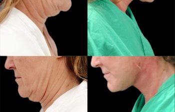 female patient before and after Eve Lift procedure