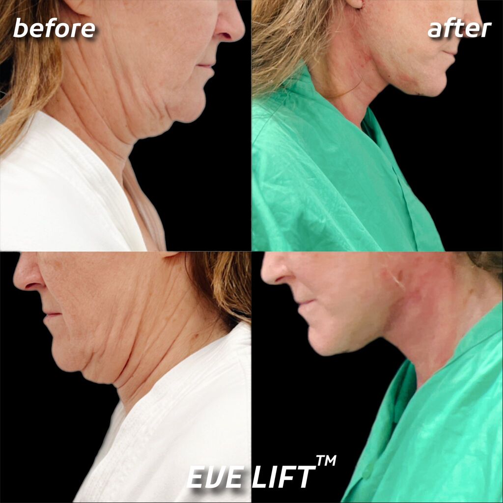 female patient before and after Eve Lift procedure