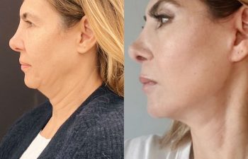 female patient before and after Eve Lift procedure