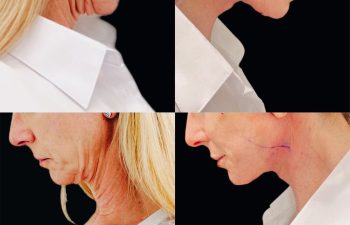 female patient before and after Eve Lift procedure