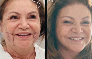 female patient before and after Eve Lift procedure