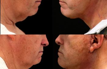 male patient before and after Eve Lift procedure
