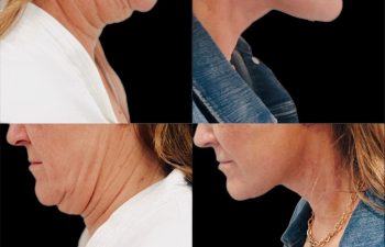 female patient before and after Eve Lift procedure