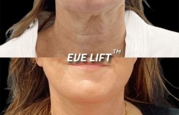 female patient before and after Eve Lift procedure