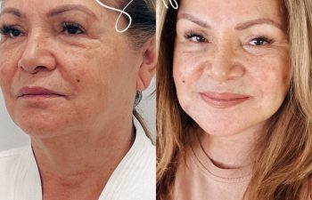 female patient before and after Eve Lift procedure