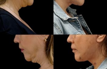 female patient before and after Eve Lift procedure