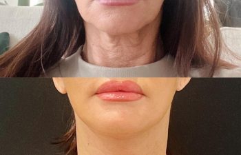 female patient before and after Eve Lift procedure