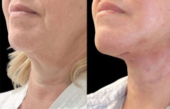 female patient before and after Eve Lift procedure