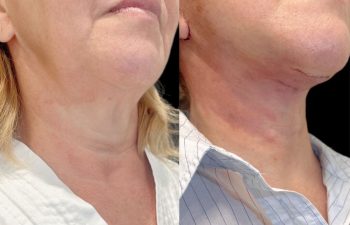 female patient before and after Eve Lift procedure