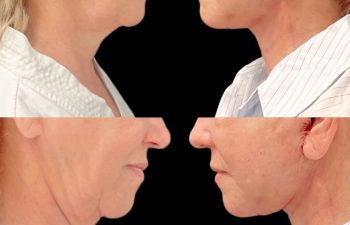 female patient before and after Eve Lift procedure