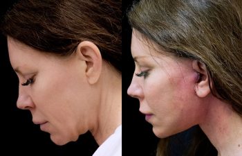female patient before and after Eve Lift procedure