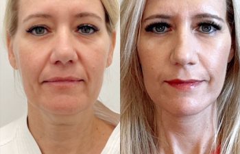 female patient before and after Eve Lift procedure