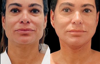 female patient before and after Eve Lift procedure