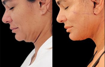 female patient before and after Eve Lift procedure