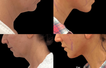 female patient before and after Eve Lift procedure