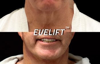 male patient before and after Eve Lift procedure
