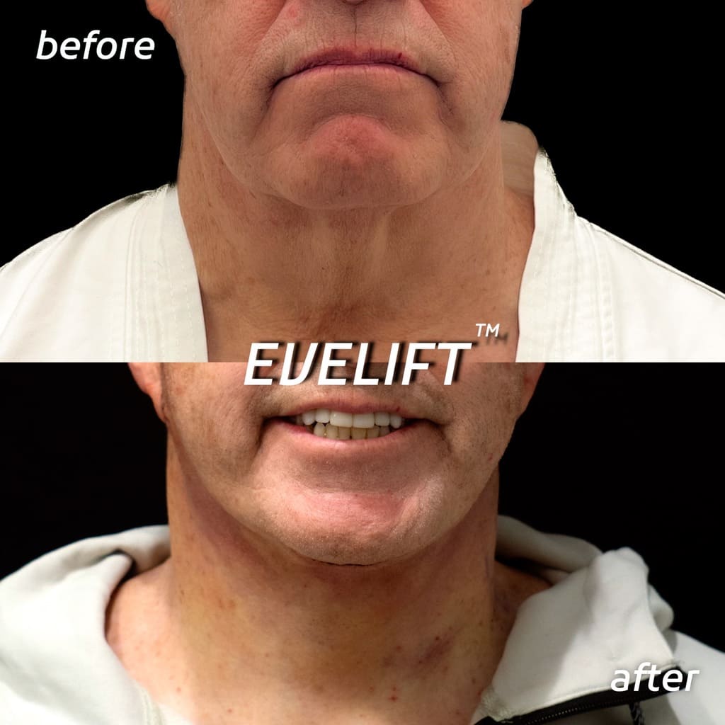 male patient before and after Eve Lift procedure