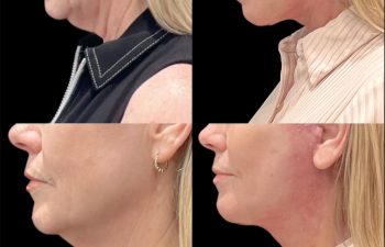 female patient before and after Eve Lift procedure