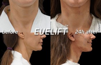 Eden Plastic Surgery Institute female patient's face before and after Eve lift procedure.