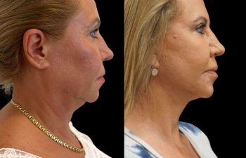 female patient before and after Eve Lift procedure
