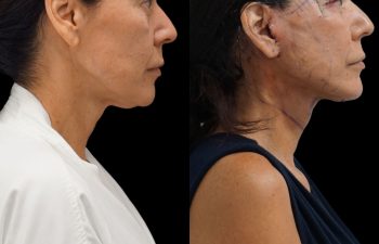 Eden Plastic Surgery Institute female patient's face before and after Eve lift procedure.