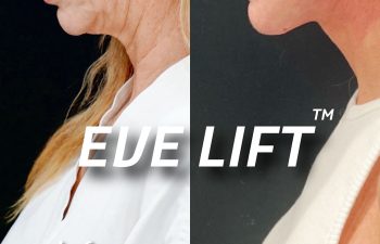 female patient before and after Eve Lift procedure