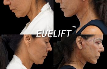 Eden Plastic Surgery Institute female patient's face before and after Eve lift procedure.