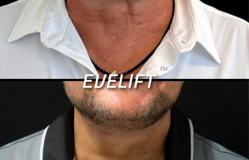 male patient before and after Eve Lift procedure