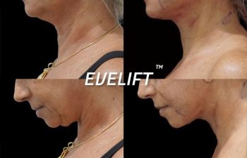 female patient before and after Eve Lift procedure