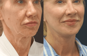 female patient before and after Eve Lift procedure