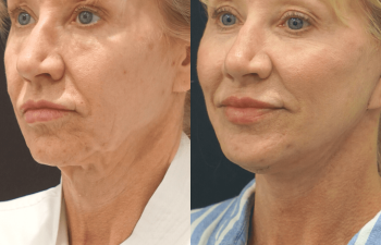 female patient before and after Eve Lift procedure