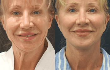 female patient before and after Eve Lift procedure