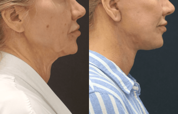 female patient before and after Eve Lift procedure