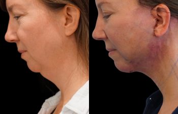 Eden Plastic Surgery Institute female patient's face before and after Eve lift procedure.