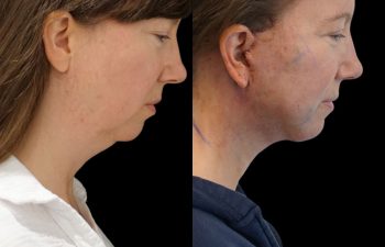 Eden Plastic Surgery Institute female patient's face before and after Eve lift procedure.