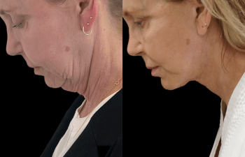 female patient before and after Eve Lift procedure