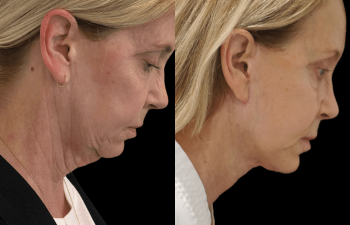 female patient before and after Eve Lift procedure